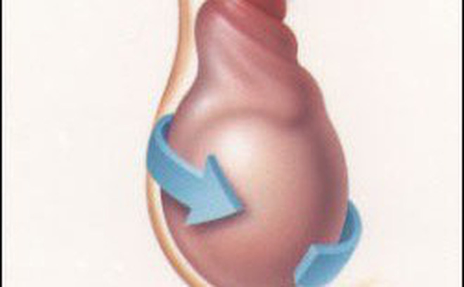 Xoắn tinh hoàn - Hình ảnh minh họa